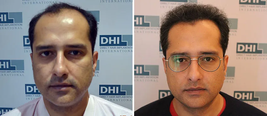 dhi gives natural hairline