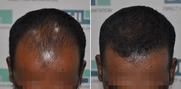 DHI before & after hair transplant results