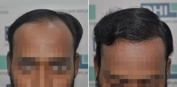 DHI before & after hair transplant results