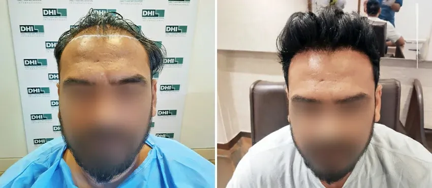 DHI before & after hair transplant results