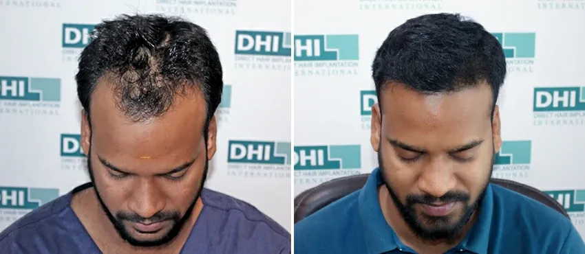 dhi gives natural hairline