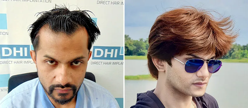 DHI before & after hair transplant results