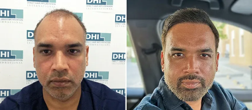 dhi gives natural hairline