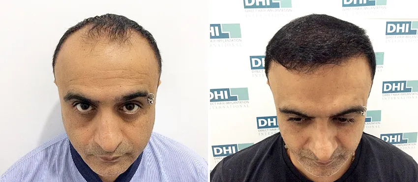 dhi gives natural hairline