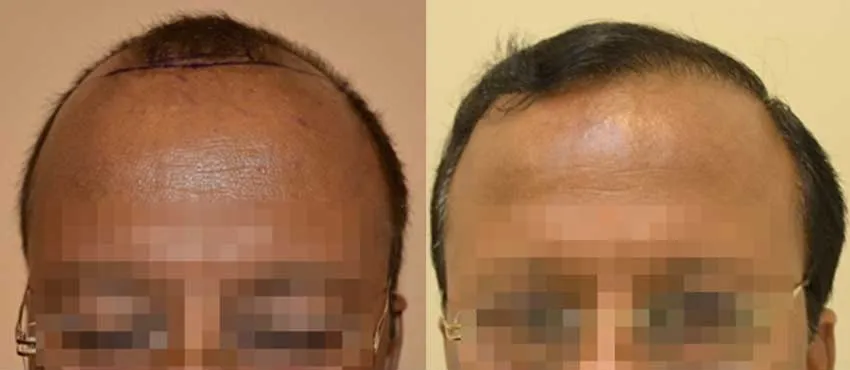 dhi gives natural hairline
