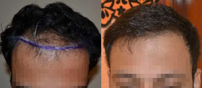 DHI before & after hair transplant results