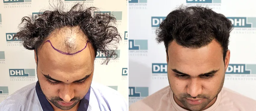 dhi gives natural hairline