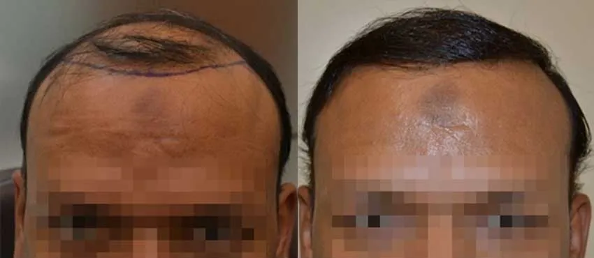 DHI before & after hair transplant results