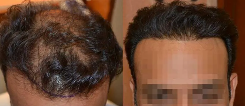 DHI before & after hair transplant results