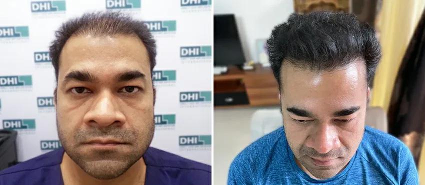 dhi gives natural hairline