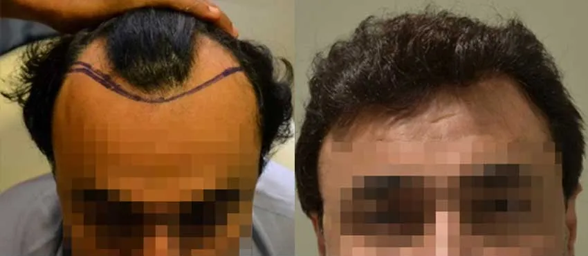 DHI before & after hair transplant results