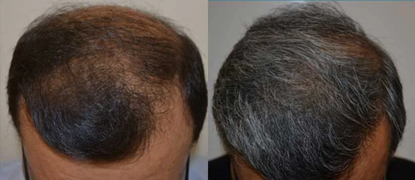 DHI before & after hair transplant results