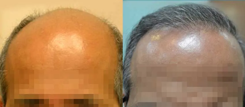 S.V. Sunil before and after