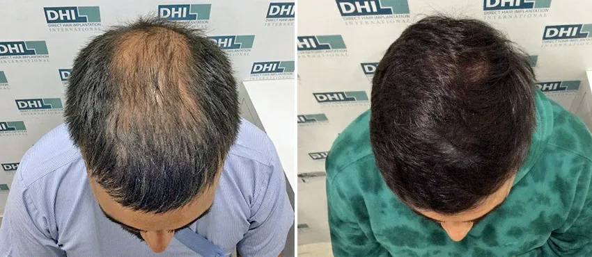 dhi gives natural hairline