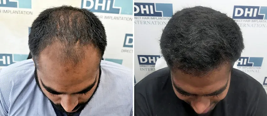 dhi gives natural hairline