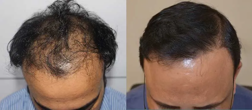 DHI before & after hair transplant results