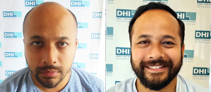 dhi gives natural hairline