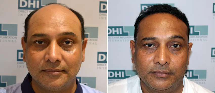 dhi gives natural hairline