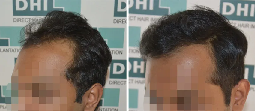 DHI before & after hair transplant results
