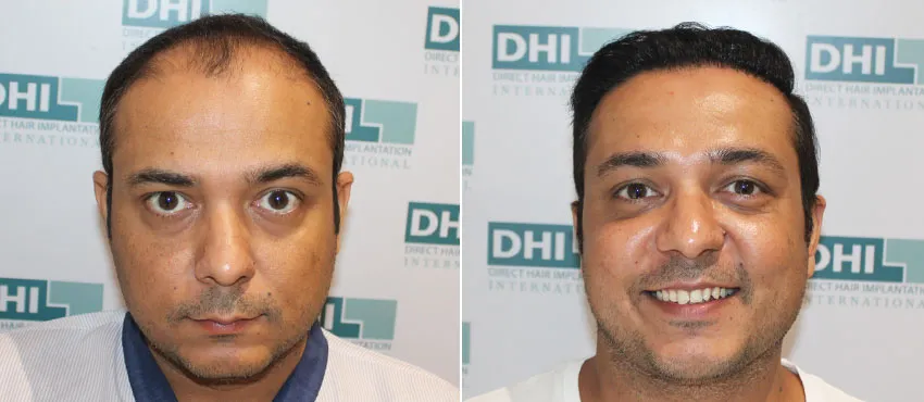dhi gives natural hairline