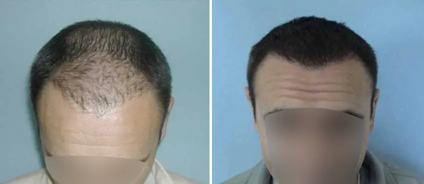 DHI before & after hair transplant results