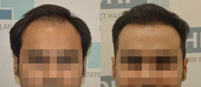 DHI before & after hair transplant results