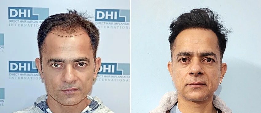 DHI bsfefore & after hair transplant results