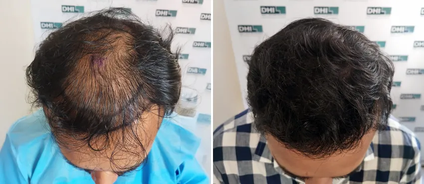 dhi gives natural hairline