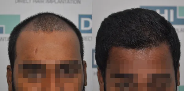 DHI before & after hair transplant results