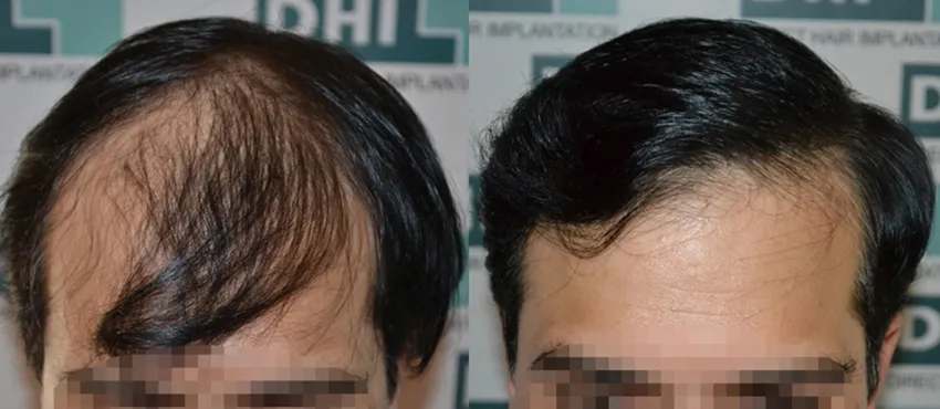 DHI before & after hair transplant results