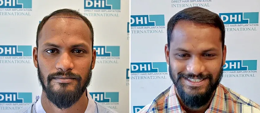 dhi gives natural hairline
