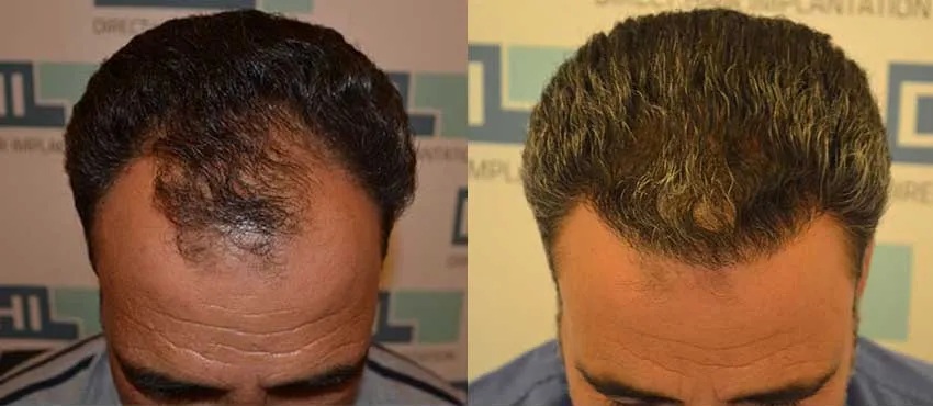 DHI before & after hair transplant results