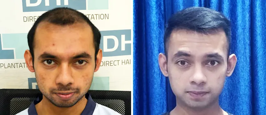 dhi gives natural hairline