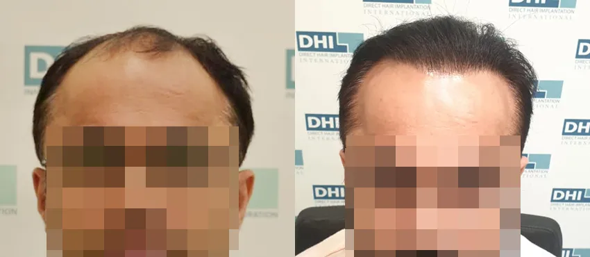 DHI before & after hair transplant results