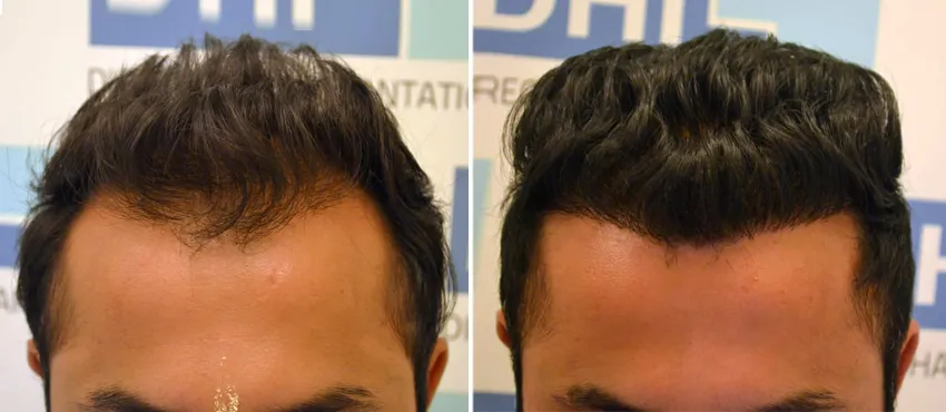 DHI before & after hair transplant results