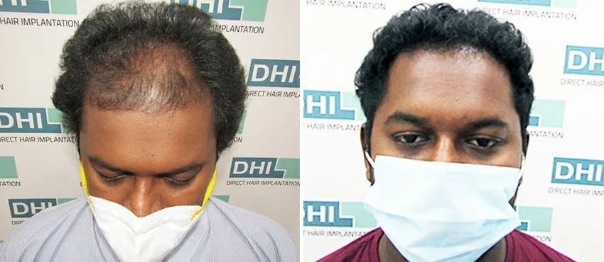 dhi gives natural hairline