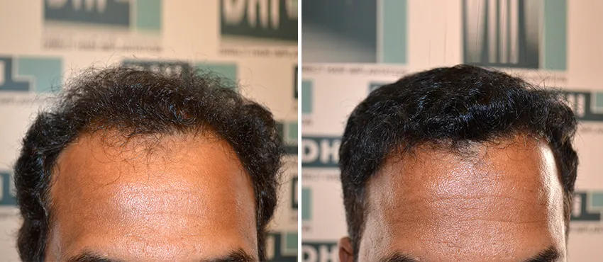 DHI before & after hair transplant results