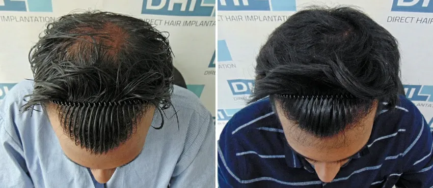 dhi gives natural hairline