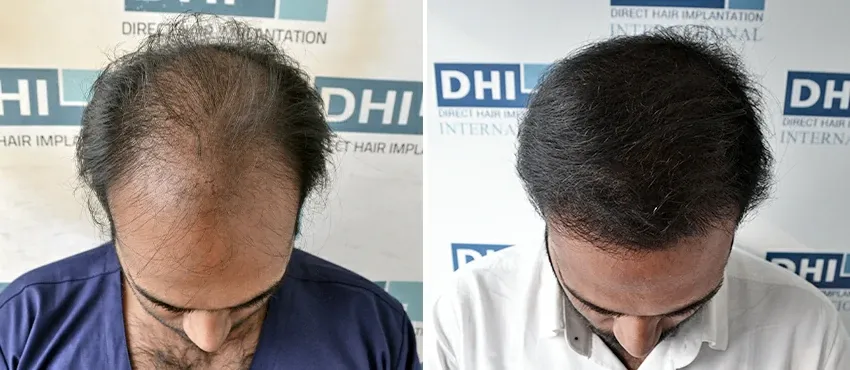 dhi gives natural hairline