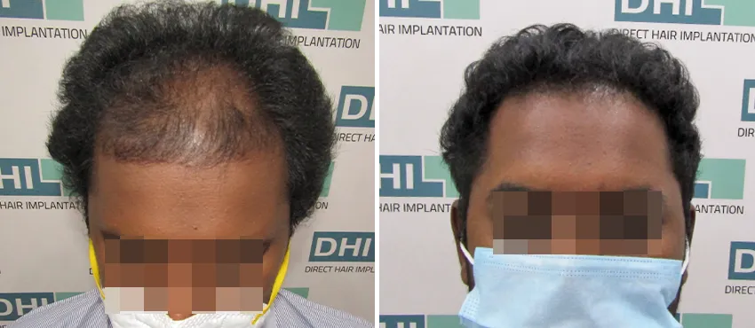 DHI before & after hair transplant results