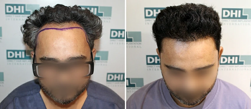 DHI before & after hair transplant results