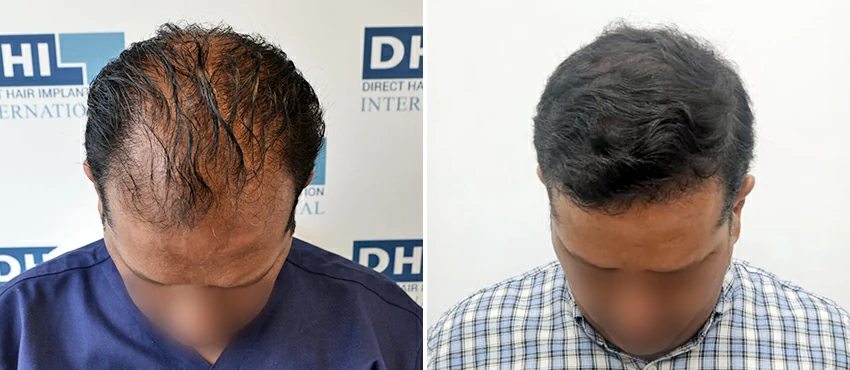 DHI before & after hair transplant results