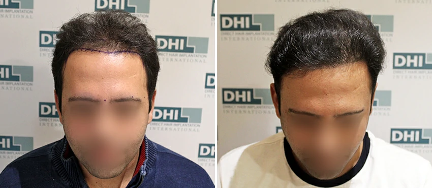DHI before & after hair transplant results