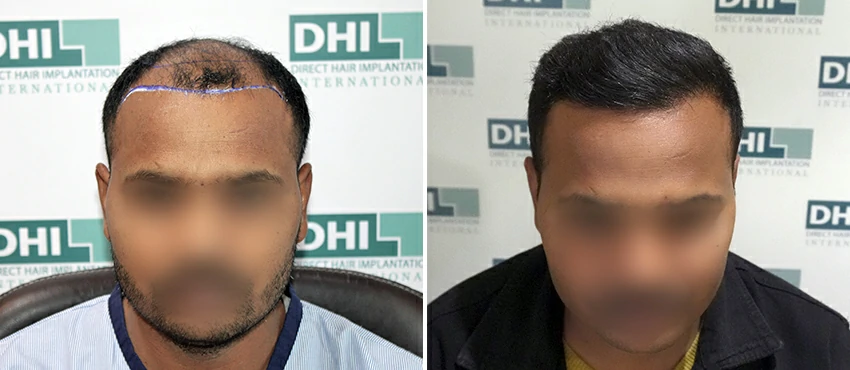 DHI before & after hair transplant results
