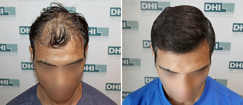 DHI before & after hair transplant results
