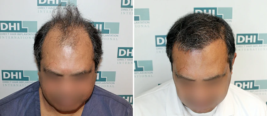 DHI before & after hair transplant results