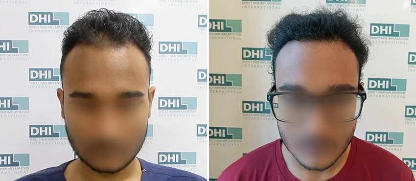 DHI before & after hair transplant results