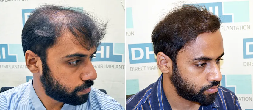 dhi gives natural hairline