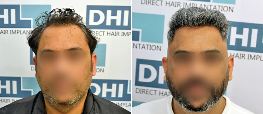 DHI before & after hair transplant results