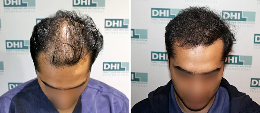 DHI before & after hair transplant results